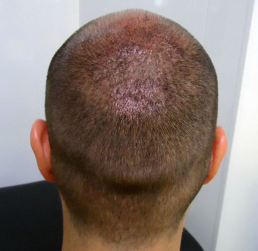 Dermo Syl - Micropigmentation des cheveux