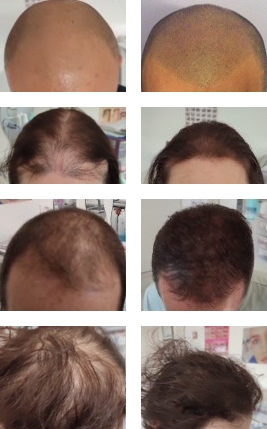 Dermo Syl - Micropigmentation des cheveux