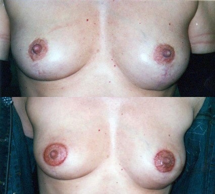 Dermo Syl - Reconstruction aréole mammaire