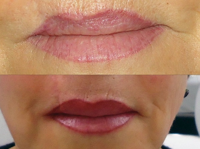 Dermo Styl - Dermopigmentation des lèvres