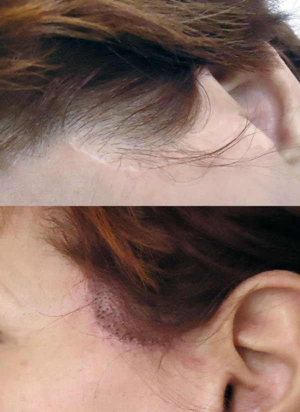 Dermo Styl - Atténuation cicatrice de lifting